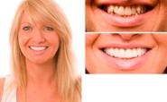 smile improved by veneers