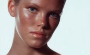 sunburned woman sunburned woman