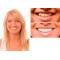 smile improved by veneers